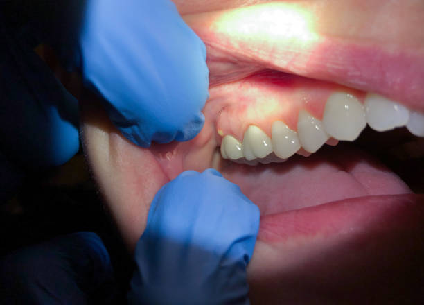 Best Urgent Tooth Repair  in Abbeville, GA