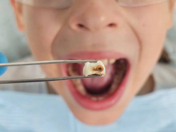Best Tooth Infection Emergency Dentist  in Abbeville, GA